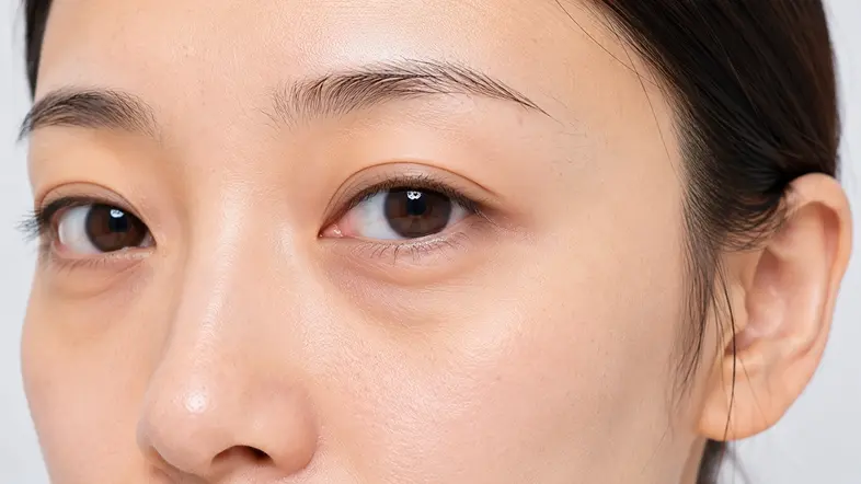 Thermage Eye 450高能量眼部疗程前参考图